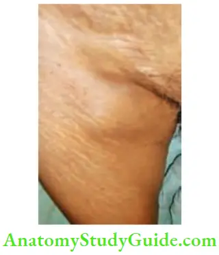 Skin Tumours Large Lymp Nodes In The Groin