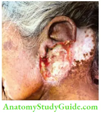 Skin Tumours Large Penetrating Baso Squamous Cell Carcinoma With DeStruction Of The Left Ear And Infiltrating Mastoid Process And External Ear