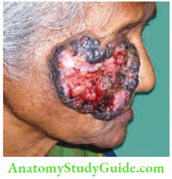Skin Tumours Lateral View Of The Same Patient Showing Elevated Edge A Few Areas Of Scab And Slough