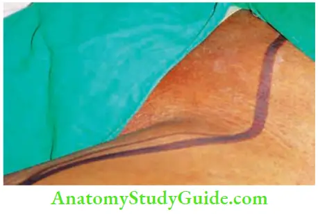 Skin Tumours Lazy S Incision Is Given For Inguinal Block Dissection This Incision Decreases Incidence Of Flap Necrosis
