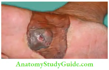 Skin Tumours Local Recurrence Skin Tumours After 2 Years Probably Because Of Inadequate Local Excision You Can See The Previous Skin Graft