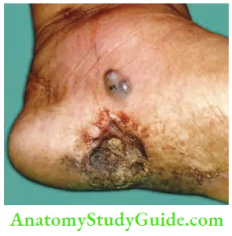 Skin Tumours Malignant Melanoma Operated Recurrence After 8 Months With Satellite Nodule