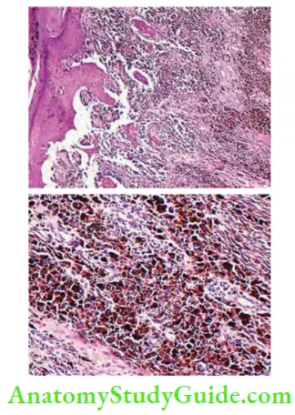 Skin Tumours Malignant Melanoma With Malignant Cells Showing Dark Melanin Pigment Inside. Second Picture Is A Close Up View