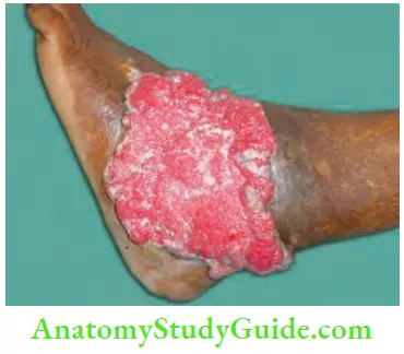 Skin Tumours Marjolin Ulcer Arising In A Burns Scar