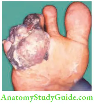 Skin Tumours Nodular