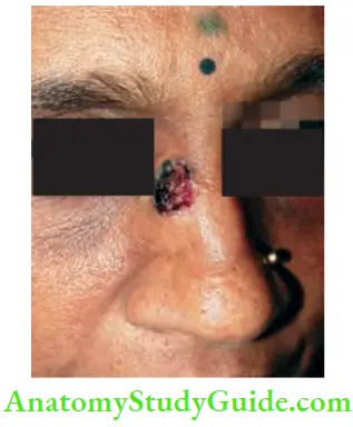 Skin Tumours Nonhealing Ulcer Of 3 Years Duration Lesion That Does Not Heal And Grows Slowly History Of BCC