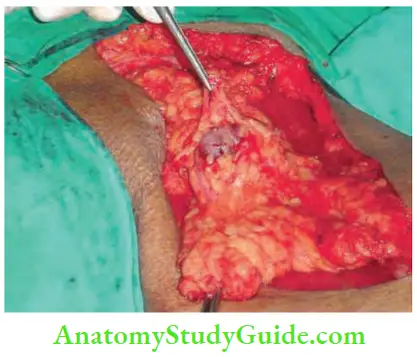 Skin Tumours Observe Pigmented Lymph Nodes