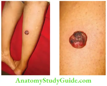 Skin Tumours Only Complaint Of This 28 Years Old Laddy Was An Increase In The Size And Oozing From The Lesion