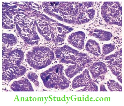 Skin Tumours Palisading Islands Of Basaloid Cells Seen In BCC