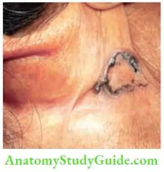 Skin Tumours Pigmented, Elevated Lesion 5 Years Duration