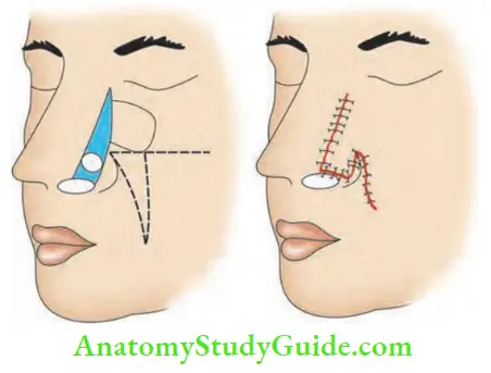 Skin Tumours Reconstruction With Nasolabial Flap Following Excision