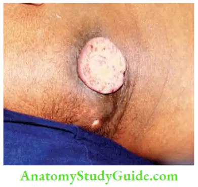 Skin Tumours Sebaceous Carcinoma