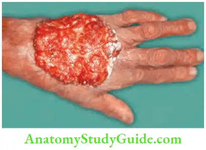Skin Tumours Squamous Cell Carcinoma Affecting Dorsum Of The Hand Ulcerproliferative Lesion