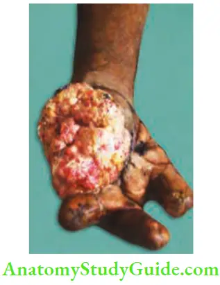 Skin Tumours Squamous Cell Carcinoma Arising In Leprosy Scar