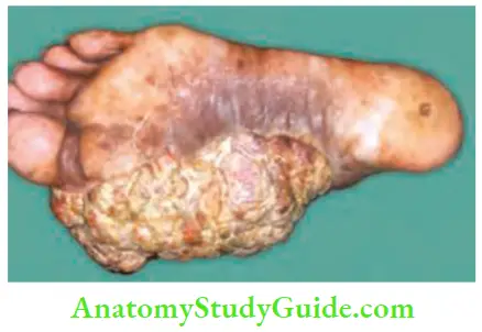 Skin Tumours Squamous Cell Carcinoma Of The Sole