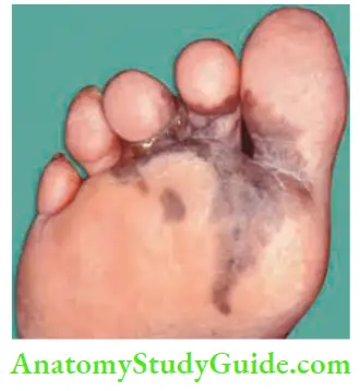 Skin Tumours Superficial Spreading