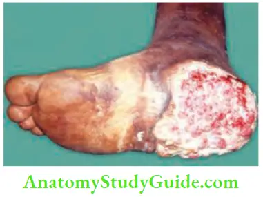 Skin Tumours The Lesion Resembles Squamous Cell Carcinoma. Punch Biopsy Reported As Amelanotic Melanoma