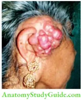 Skin Tumours Turban Tumour