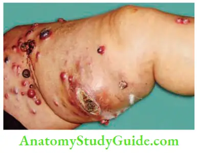Skin Tumours Whole Leg Id Studded With Tumour. In Transit Deposits From Malignant Melanoma Of The Foot