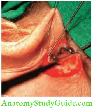 Skin Tumours Wide Excision In Progress