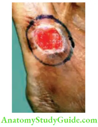 Skin Tumours Wide Excision Of Squamous Cell Carcinoma