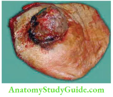 Skin Tumours Wide Excision Specimen