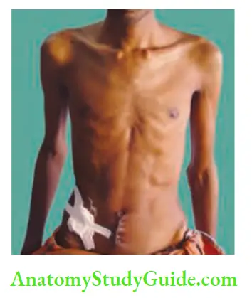 Small Intestine An emaciated patient who underwent appendicectomy