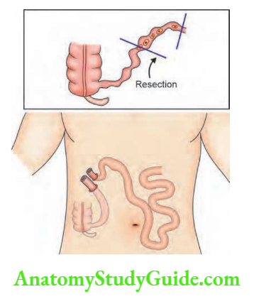 Small Intestine Both ends brought outside small bowel exteriorisation