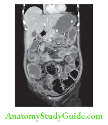Small Intestine CECT scan Crohn’s disease showing thickening of intestinal loops
