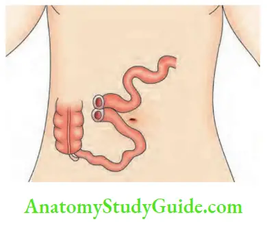 Small Intestine Loop ileostomy is done following resection of perforated enteric ulcer