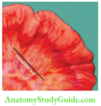 Small Intestine Observe blood supply of the mesentery and it is natural that a horizontal tear causes more gangrene