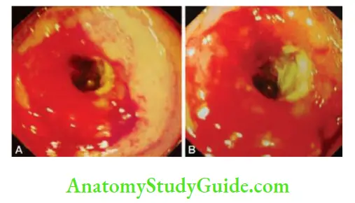 Small Intestine Push enteroscopy showing ulcerative lesion in the proximal jejunum