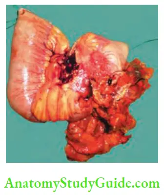 Small Intestine Resection of the growth done with 6 cm margin with lymph nodes