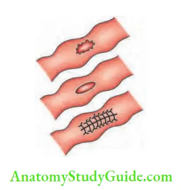 Small Intestine Single ulcer simple suturing