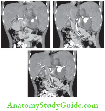 Spleen A 28 Year Old Man Presented With Pain Abdomen