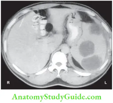 Spleen CT Scan Shoeing Multiple Splenic Abscesses