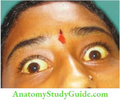 Spleen Case Of Hereditary Spherocytosis With Faint Jaundice In A 22 Year Old Girl