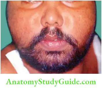 Spleen Felty's Syndrome The Patient Had Received Steroids For One Year