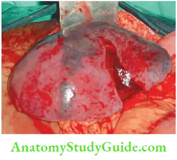 Spleen Large Laceration Of The Spleen