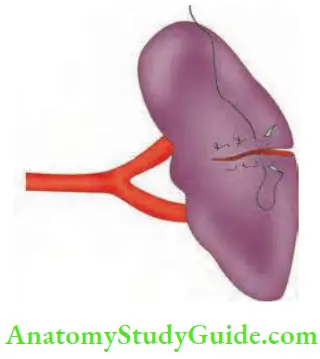 Spleen Partial Splenectomy
