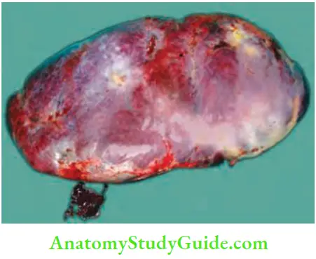 Spleen Patient Had Pyrexia Of Unknown Origin With Pancytopaenia