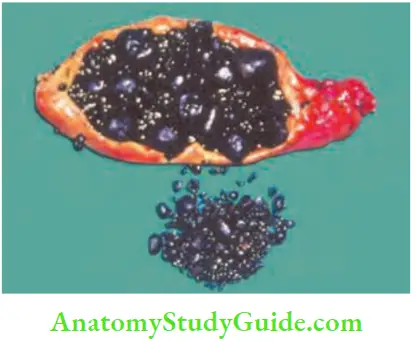 Spleen Pigment Stones