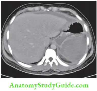 Spleen Post Splenectomy Large Collection