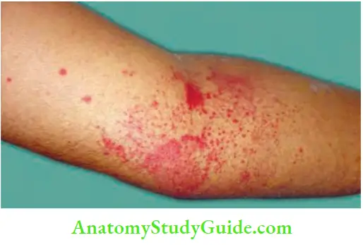 Spleen Purpic Spots In The Forearm