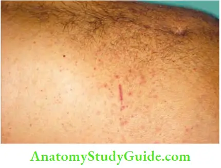 Spleen Purpuric Spots On The Abdomen