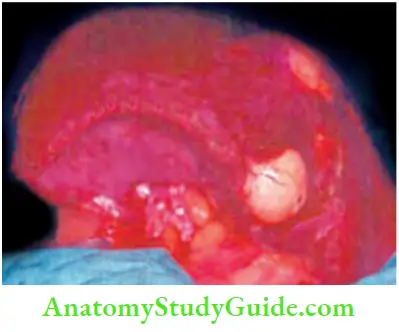 Spleen Same Patient With Multiple Abscesses In The Spleen