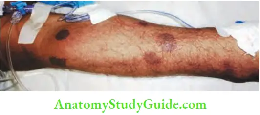 Spleen Severe Sepsis With Thrombocytopenia