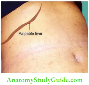 Spleen She Had 2 cm Enlarged Liver And Gallstones