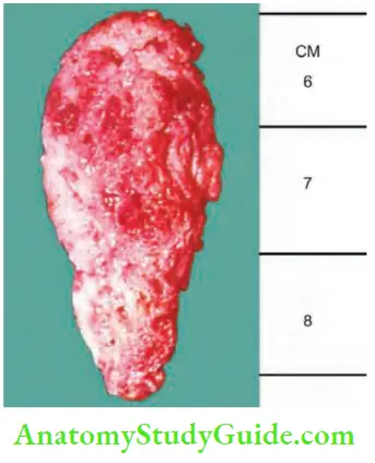 Spleen Sickel Cell Anaemia