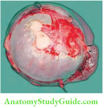 Spleen Simple Cyst Of The Spllen Resulting In Compression Of The Spleen